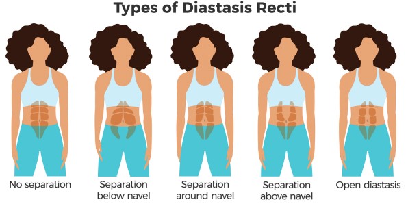 What is Diastasis Recti?